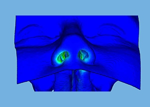 Image of the representation of the wall shear stress in the nostrils of the patient.