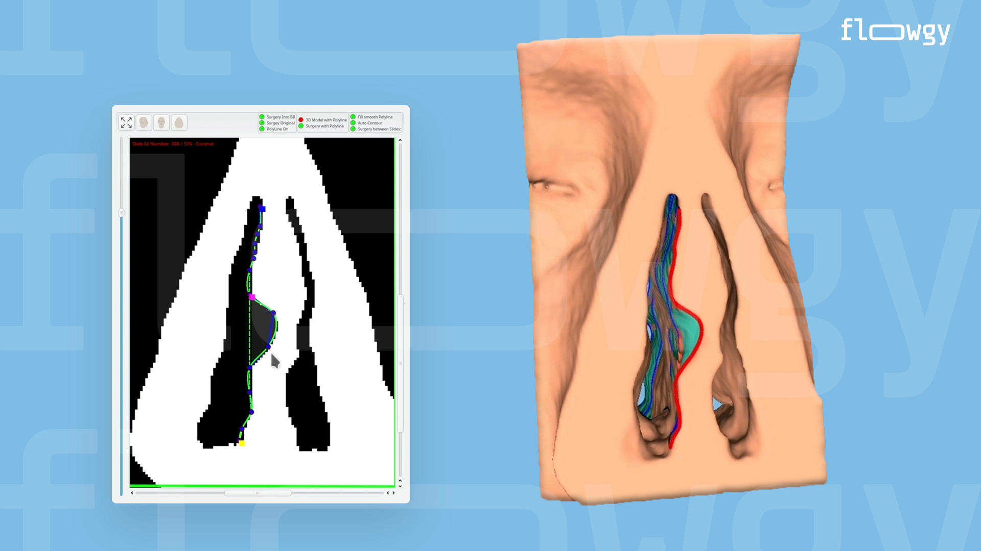 Nasal surgery using virtual surgery techniques with Flowgy.