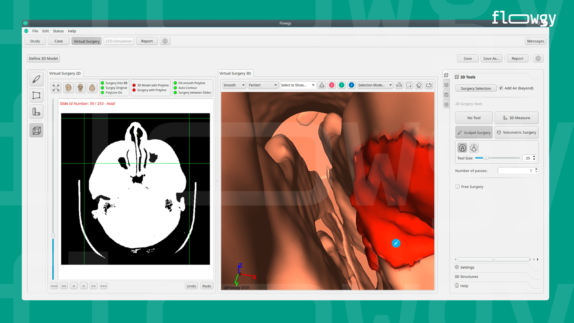 Example of virtual surgery of a septal deviation made by Flowgy.