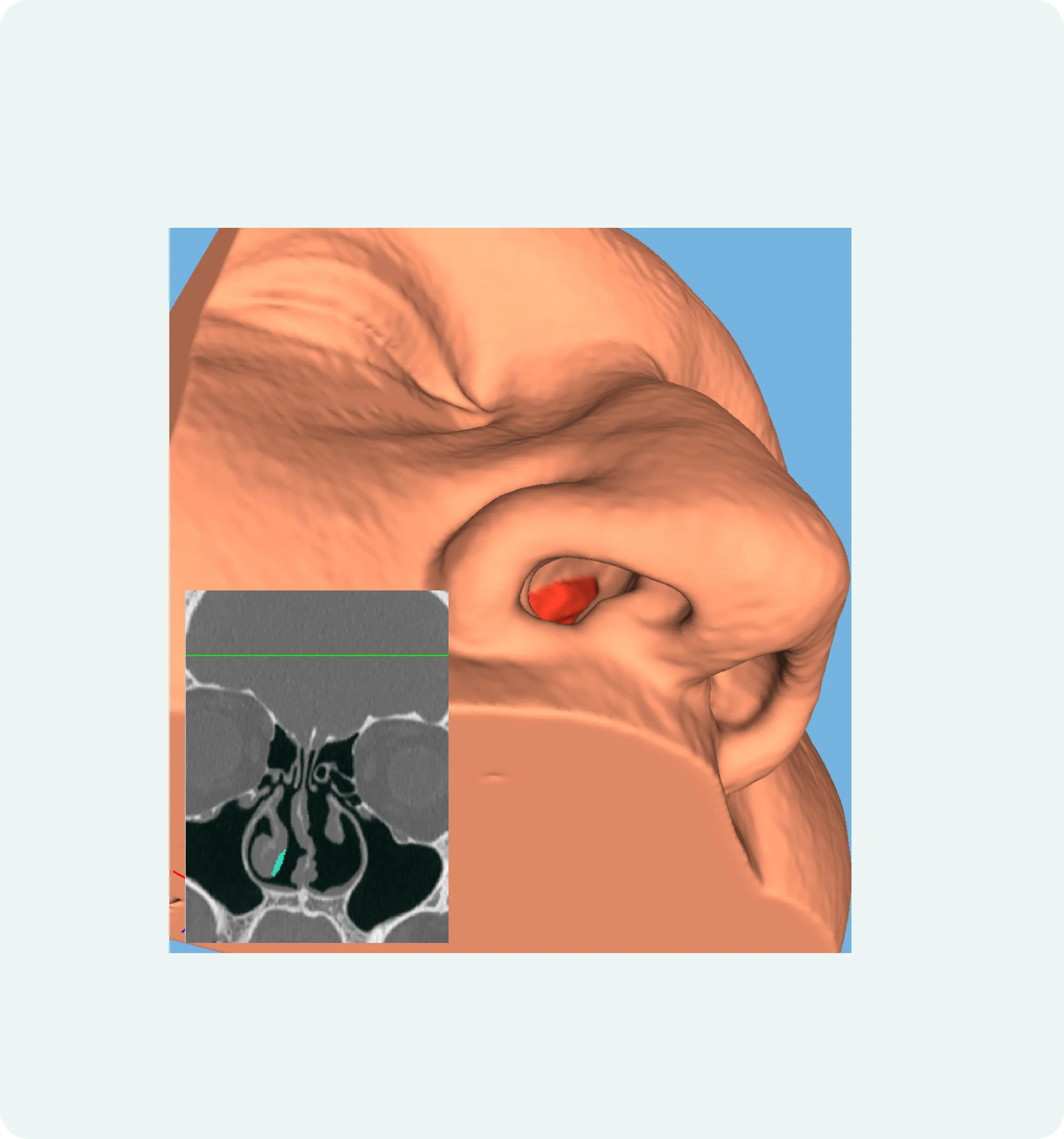 Advanced simulations in Flowgy for medical research.